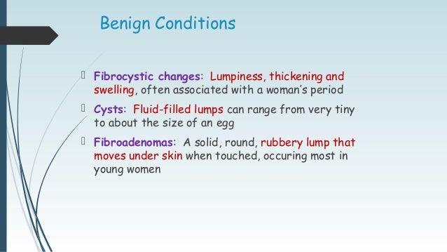 breast cysts benign Breast cysts benign